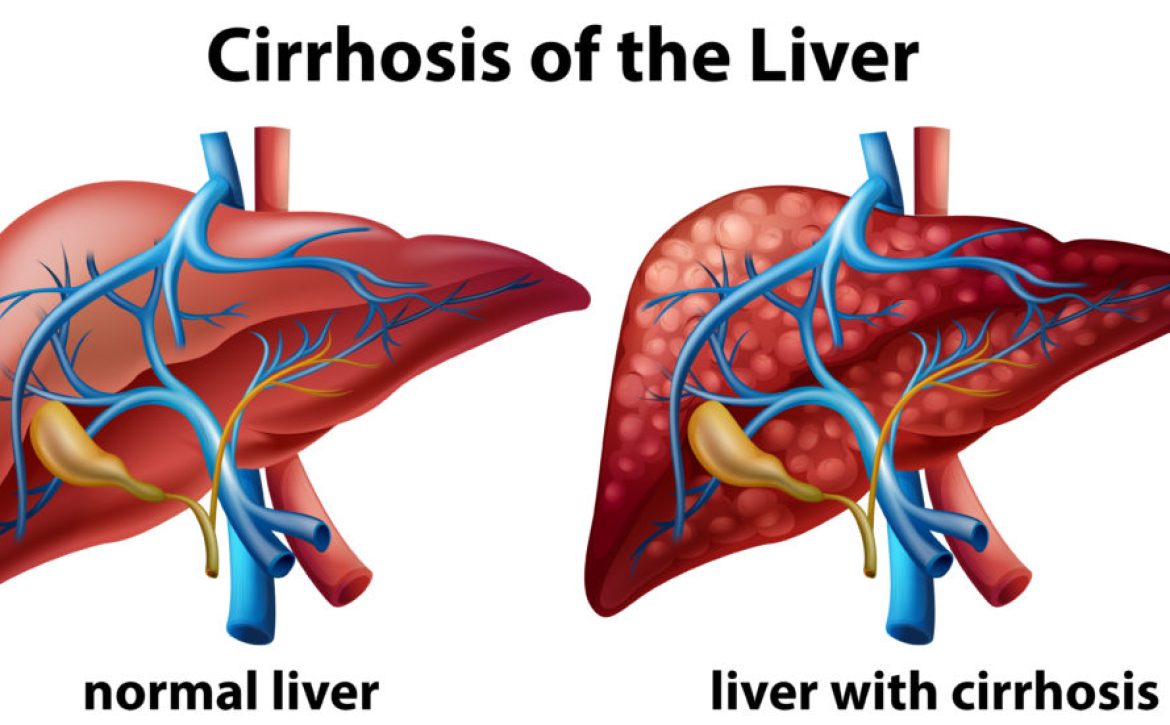 liver_cirrhosis