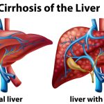 Understanding Liver Cirrhosis: Causes, Symptoms, and Management