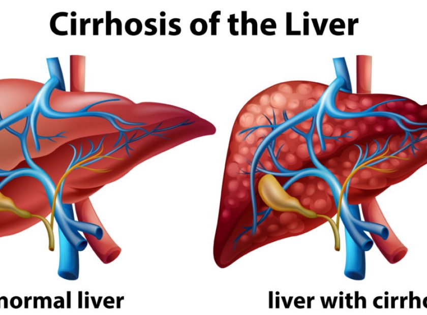 liver_cirrhosis