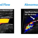 5 Vital Reasons Why You Should Consider a Carotid Doppler Ultrasound