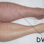 Step-by-Step Guide: What to Expect During a DVT Ultrasound Scan