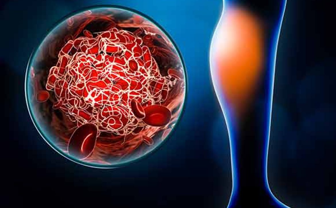 deep vein thrombosis