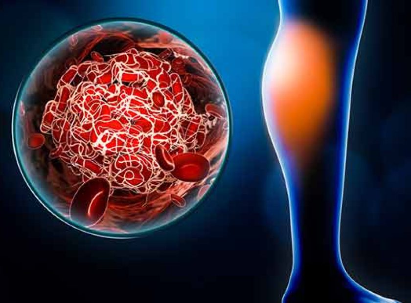 deep vein thrombosis