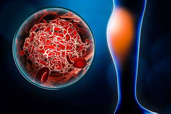 deep vein thrombosis