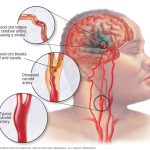 The Ultimate Guide to Preparing for a Carotid Doppler Ultrasound